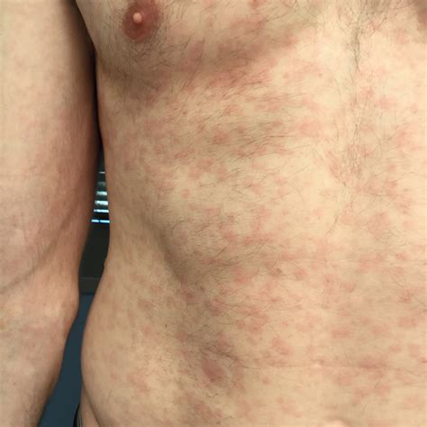 Syphilis | Florida Department of Health in Sarasota