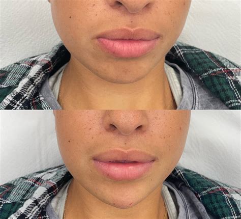 Aesthetics Southampton | Lip Fillers | Corinne Williams : Corinne ...