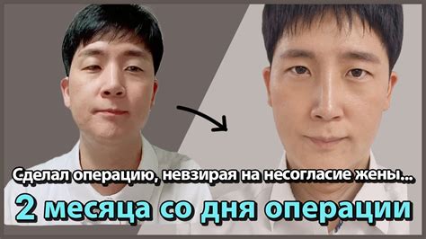 Отзыв пациента_2 месяца после операции 👁️👃🏻👁️ (неинвазивная коррекция ...