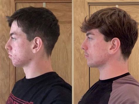 Does Mewing Change Your Face Shape and How? | Mewing.coach