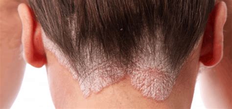 Natural Remedies for Scalp Psoriasis Relief: Effective Treatment Tips
