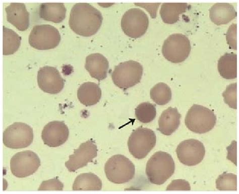 Morphology of erythrocytes in the blood smear (Wright-Giemsa stain ...