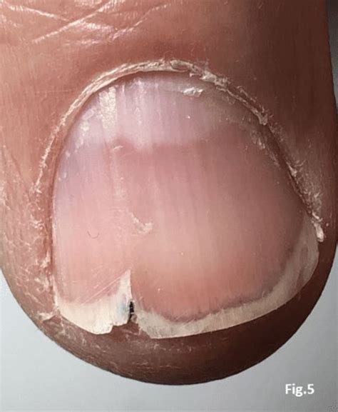 Brittle Nails: Causes, Prevention, and Treatment - NailKnowledge