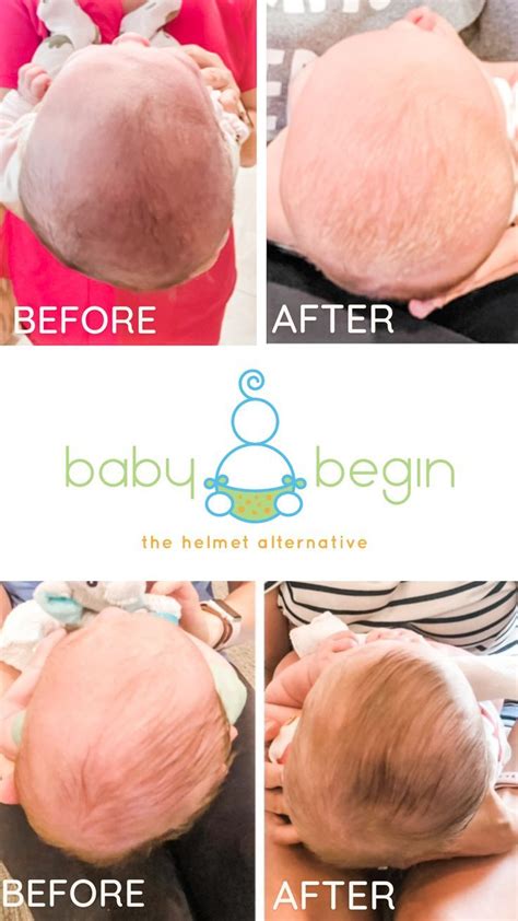 Plagiocephaly Correction without a Helmet | Before baby, Baby helmet, Baby