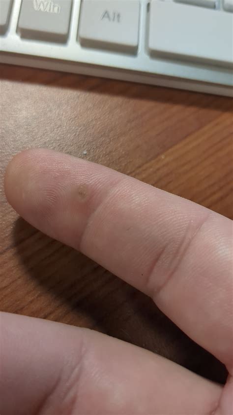 Does this look like a wart? : r/Warts