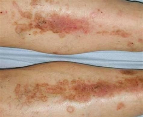 What is Diabetes Dermopathy?
