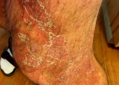Cow Parsley Rash