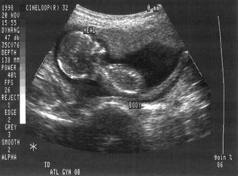 Ultrasounds Save Unborn Babies | Caffeinated Thoughts