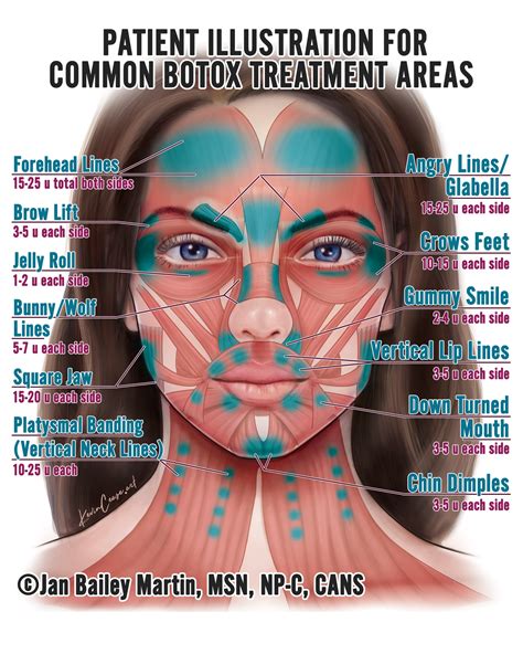 Patient Illustration for Botox injection | artbykevincease | Botox