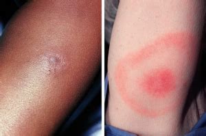Lyme Disease UK - Lyme Disease and the EM Rash