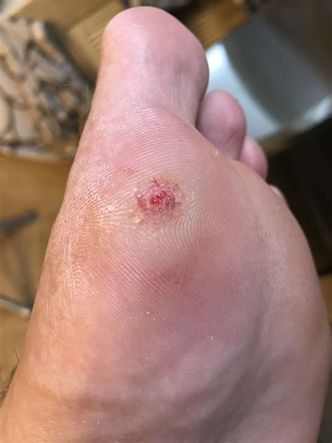Plantar Wart Removal Scar at Lucy Gardiner blog