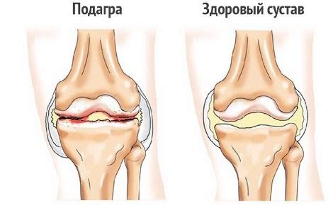 Мочегонные препараты при высоком давлении - DavlenieNorm