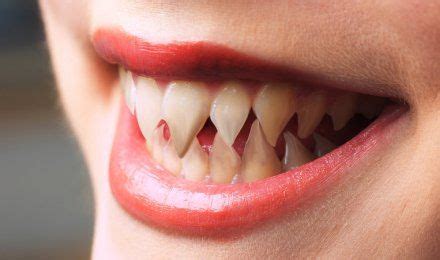 People With Sharp Teeth