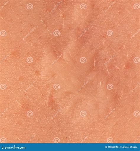 Scar on Human Skin after Heart Surgery Stock Photo - Image of damage, surgery: 298602294