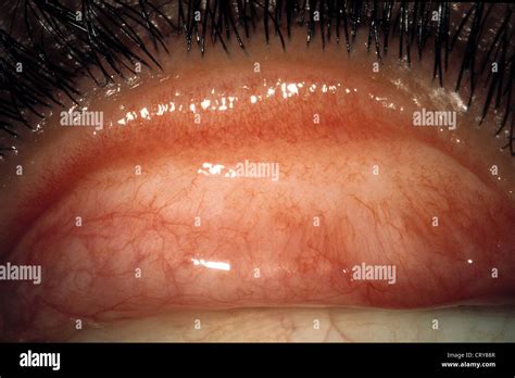 Trachoma hi-res stock photography and images - Alamy