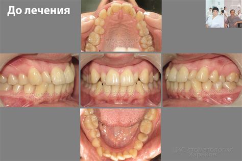 Брекеты до и после