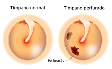 Como Saber Se O Tímpano Estourou