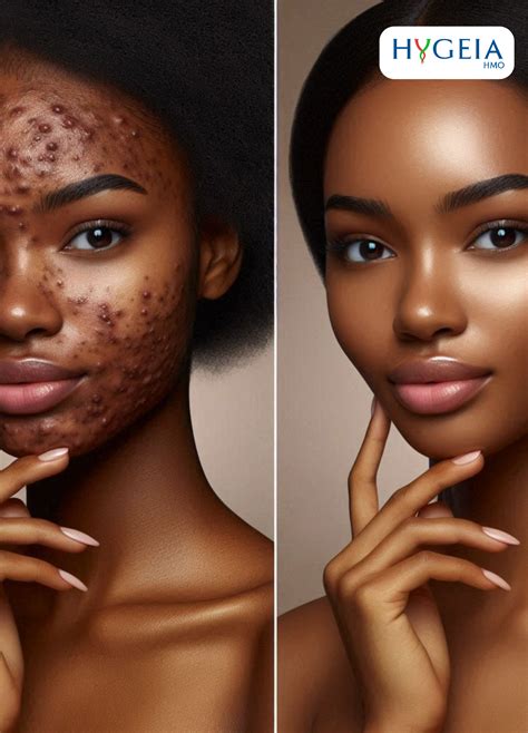 CLEAR SKIN: BANISHING ACNE