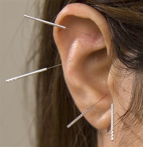 Auricular Acupuncture - Acupuncture Exeter