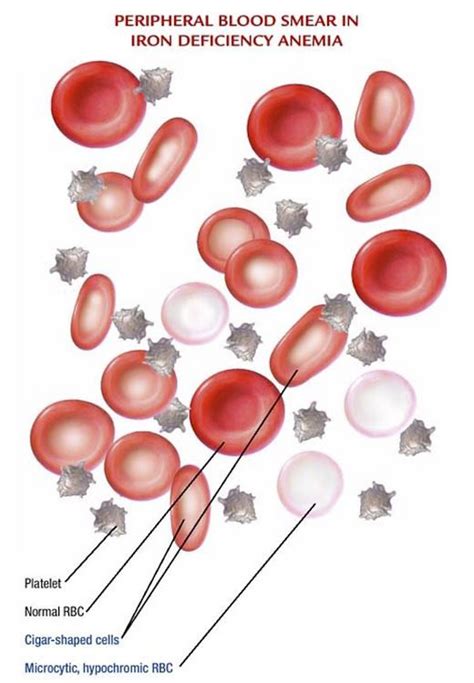 Iron Deficiency Anaemia Explained