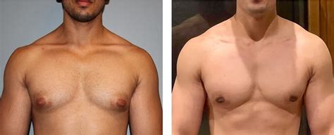 Gynecomastia – symptoms, causes, and treatment | MedTour