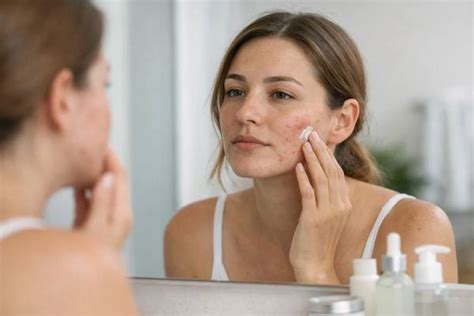 pcos  acne hormones skincare  medication options vitalibrary