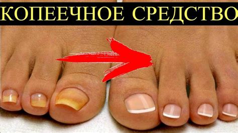 Копеечное средство из Аптеки от Грибка ногтей и стоп! Так Просто и ...