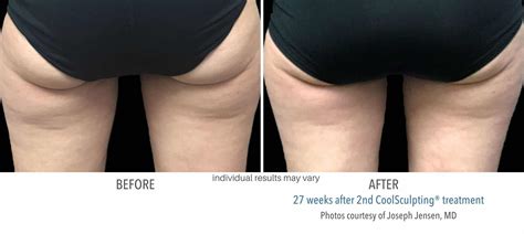 CoolSculpting Thighs | Perfect for Upper, Lower, and Inner Thighs