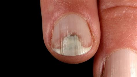 Onycholysis