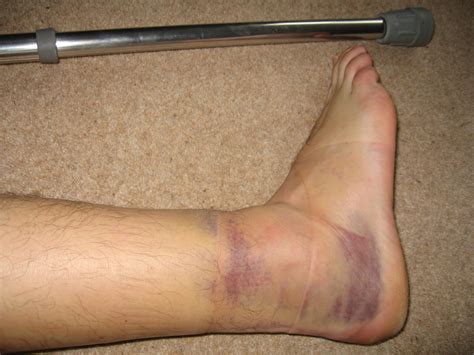 Swollen Ankle Sprain