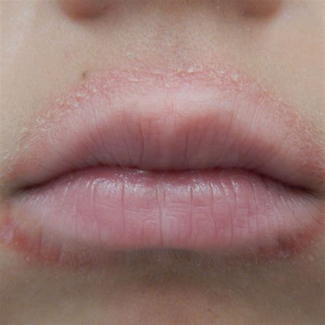 What Are Purple Lips A Symptom Of | Lipstutorial.org