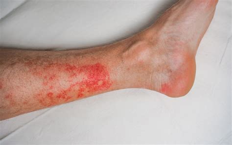 Hiker's Rash, Explained: 6 Ways To Treat It + How To Keep Hiking