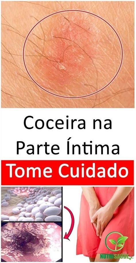 Coceira No Anus E Na Vagina - Coceira na Parte Intima Tome Cuidado! | Coceira, Gonorreia, Remédios ...