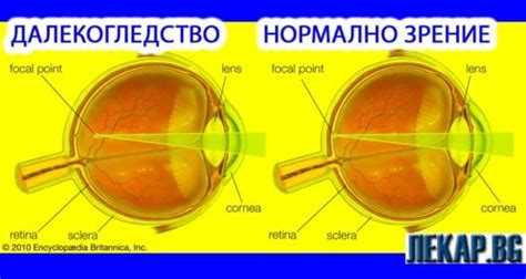 Далекогледство (хиперметропия). 8 начина за лечение. Симптоми - Лекар.БГ