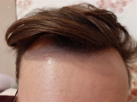 Hello guys. Is this balding or just widow's peak hairline? : r ...