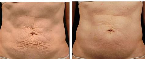tummy  thermage ny reduction thermage aesthetic clinic clear complexion