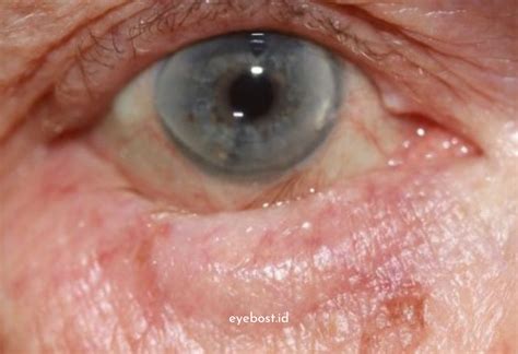 entropion  waspadai  penyebabnya