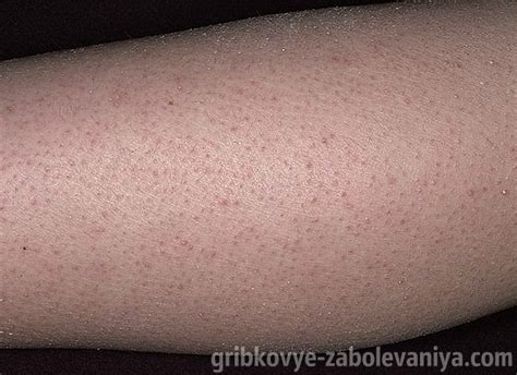 Фолликулярный кератоз фото на ягодицах