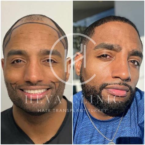 deion sanders hair transplant hair loss technical analysis