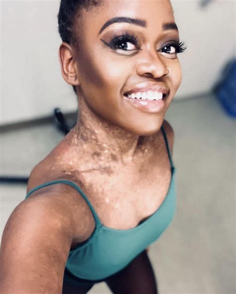 17 Famous People with Vitiligo - Living Dappled