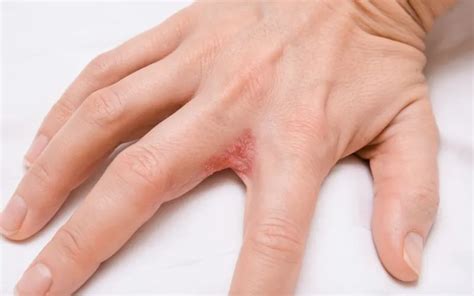 Dyshidrotic Eczema: Causes, Symptoms, and Treatment