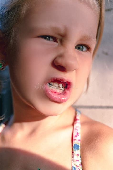 Little Girl with Crooked Teeth and Orthodontic Appliance Stock Photo ...