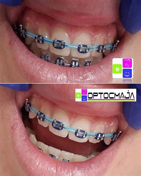 10 colored blue braces for adults and kids | Braces Explained