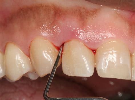 Clinica Omega: Enfermedad periodontal