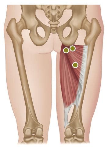 adductor tendonitis clipart   cliparts  images