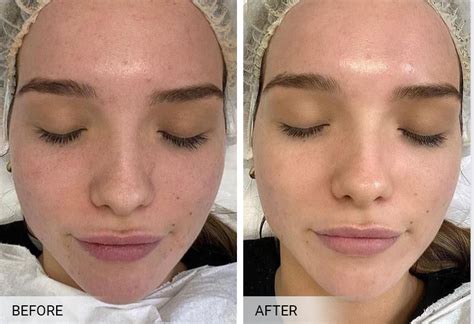 BioRepeel New York, BioRepeel Facial In Staten Island & Brooklyn ...