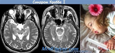 Болезнь Краббе у детей - глобоидноклеточная лейкодистрофия
