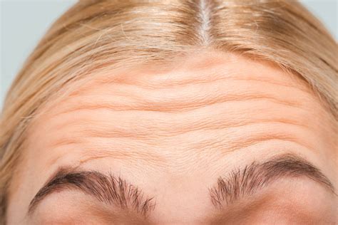 comprehensive guide  treating forehead wrinkles vanguard medical