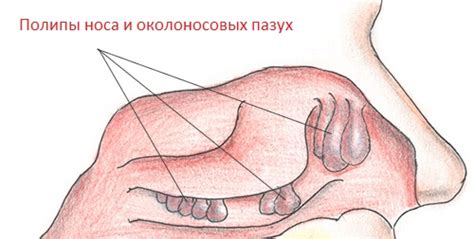 Папиллома и полип - в чем разница, или это одно и то же
