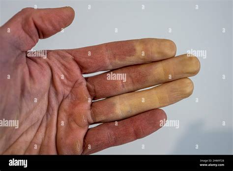 Une main masculine frostbitten avec le syndrome de Raynaud, le ...